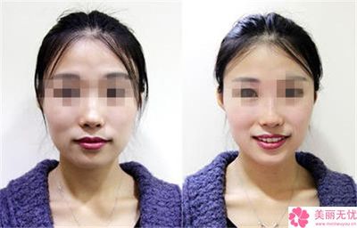 南寧市做達(dá)拉斯隆鼻哪里整形醫(yī)院好(南寧貞韓解鎖榜一)