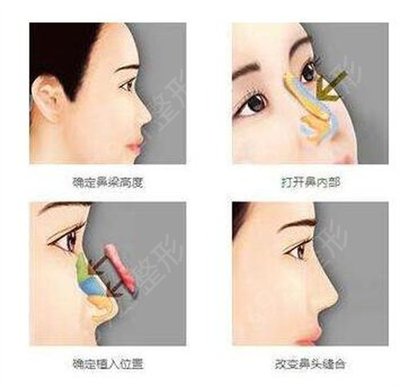 廣西醫(yī)科大學(xué)第三附屬醫(yī)院整形科做鼻子怎么樣?60天前后果不錯(cuò)!